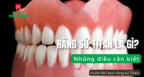 Răng Sứ Titan là gì? Những điều cần biết trước khi bọc răng sứ Titan