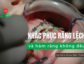 Khắc phục răng lệch và hàm răng không đều tại Nha Khoa Bến Thành