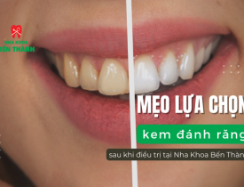 Mẹo lựa chọn đúng kem đánh răng sau phục hình tại nha khoa Bến Thành