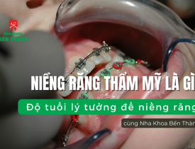 Niềng răng thẩm mỹ là gì? Độ tuổi lý tưởng để niềng răng