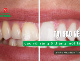 Tại sao nên cạo vôi răng 6 tháng một lần tại Nha Khoa Bến Thành