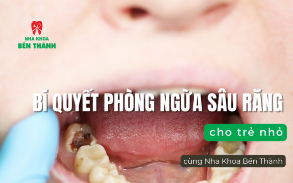 Bí quyết phòng ngừa sâu răng cho trẻ nhỏ cùng Nha Khoa Bến Thành