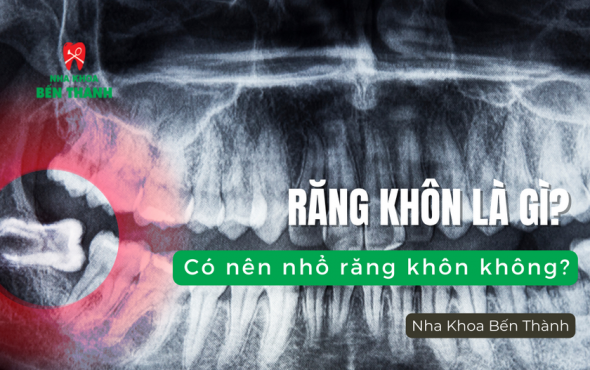 Răng khôn là gì? Có nên nhổ răng khôn không?