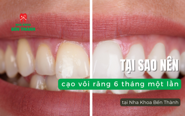 Tại sao nên cạo vôi răng 6 tháng một lần tại Nha Khoa Bến Thành